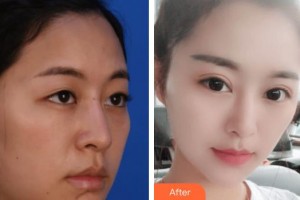 襄陽愛爾眼科醫(yī)院秦光勇整形價格表附定點雙眼皮案例展示