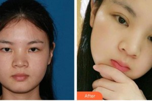 襄陽愛爾眼科醫(yī)院鄭先芬整形價格表附切開雙眼皮案例展示