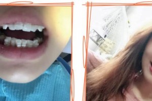 襄陽牙牙口腔門診部夏海斌整形價格表附牙齒陶瓷矯正案例展示