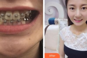 襄陽佳潔口腔醫(yī)院付士杰整形價格表附金屬托槽矯正案例展示