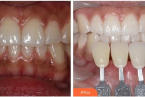 襄陽維樂口腔門診部王東濤整形價格表附冷光美白案例展示