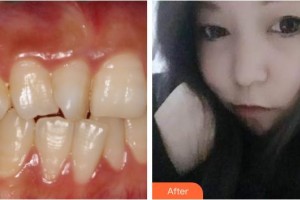 襄陽(yáng)牙牙口腔門診部王林虎整形價(jià)格表附牙齒隱形矯正案例展示