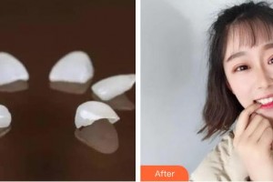 襄陽(yáng)時(shí)代口腔醫(yī)院任旭東整形價(jià)格表附美白貼片案例展示