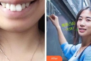 襄陽(yáng)時(shí)代口腔醫(yī)院趙恒整形價(jià)格表附金屬托槽矯正案例展示