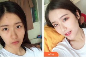 襄陽(yáng)市第一人民醫(yī)院吳小軍整形價(jià)格表附拉皮手術(shù)提升案例展示