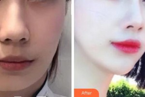 襄陽(yáng)市第一人民醫(yī)院潘穎喆整形價(jià)格表附埋線提升案例展示