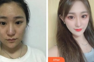 襄陽(yáng)市第一人民醫(yī)院李運(yùn)安整形價(jià)格表附激光美膚激光案例展示