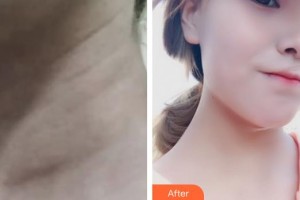 襄陽(yáng)市第一人民醫(yī)院周新春整形價(jià)格表附嗨體去頸紋案例展示