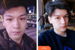 襄陽(yáng)市第一人民醫(yī)院殷暉整形價(jià)格表附埋線提升案例展示