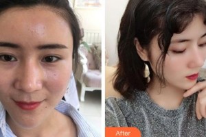 恩施華美整形美容門診部徐懷河整形價(jià)格表附鼻部綜合案例展示