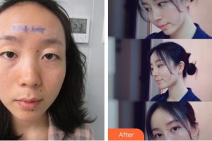 恩施華美整形美容門診部張鶴鳴整形價(jià)格表附假體隆鼻案例展示