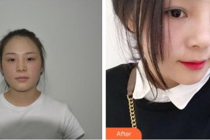 恩施中韓整形美容醫(yī)院趙東升整形價(jià)格表附隆鼻案例展示