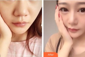 恩施州中心醫(yī)院燒傷整形科田代雄整形價(jià)格表附鼻部綜合案例展示