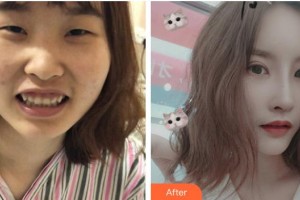 恩施愛(ài)爾眼科醫(yī)院戴守整形價(jià)格表附眼部綜合案例展示