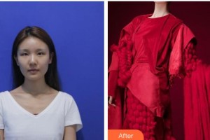 恩施慧益眼科醫(yī)院李學周整形價格表附切開雙眼皮案例展示