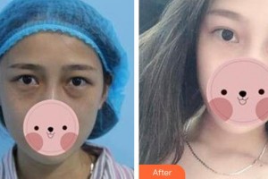 恩施慧益眼科醫(yī)院肖紫云整形價格表附內切祛眼袋案例展示