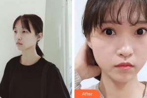 恩施慧益眼科醫(yī)院楊方列整形價格表附切開雙眼皮案例展示