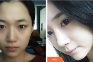 恩施慧益眼科醫(yī)院程揚整形價格表附切開雙眼皮案例展示