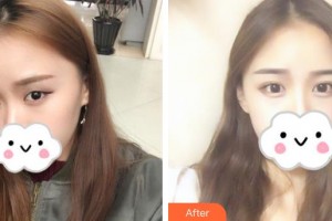 恩施慧益眼科醫(yī)院范凌志整形價格表附眼部綜合案例展示