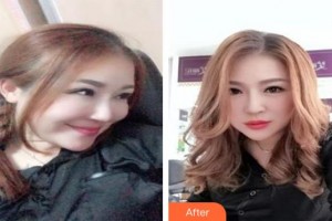 仙桃友好醫(yī)學美容醫(yī)院張志翔整形價格表附嗨體去頸紋案例展示