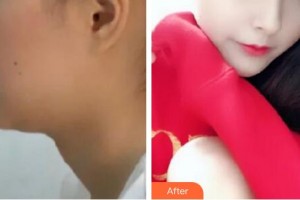 仙桃博美醫(yī)療美容醫(yī)院雷文斌整形價格表附埋線提升案例展示