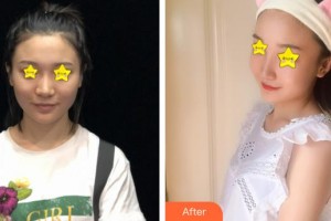 仙桃憶美醫(yī)療美容門診部解永學整形價格表附埋線提升案例展示