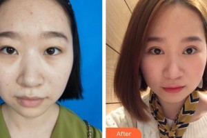 潛江藍鳥醫(yī)療美容診所黃星整形價格表附切開雙眼皮案例展示