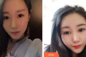 潛江藍鳥醫(yī)療美容診所黃玲華整形價格表附眼部綜合案例展示