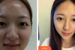 潛江亞美醫(yī)療美容診所劉敏先整形價格表附切開雙眼皮案例展示