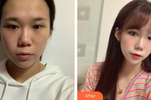 潛江白衣天使醫(yī)療美容診所江岳整形價格表附眼部綜合案例展示