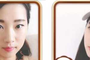 天門江岳醫(yī)療美容診所祝小麗整形價格表附定點雙眼皮案例展示