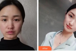 牡丹江王維群整形美容外科診所王維群整形價(jià)格表附眼部綜合案例展示