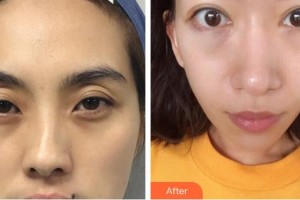 牡丹江鄒忠明整形美容外科診所鄒忠明 整形價(jià)格表附外切祛眼袋案例展示