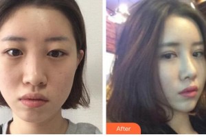 牡丹江鄒倩醫(yī)療美容診所鄒倩整形價(jià)格表附切開雙眼皮案例展示