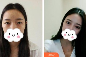 伊春市中心醫(yī)院燒傷整形外科黃耀斌整形價(jià)格表附眼部綜合案例展示