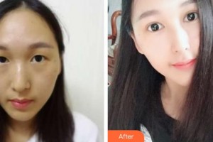 伊春王霞醫(yī)療美容診所王霞整形價(jià)格表附切開雙眼皮案例展示