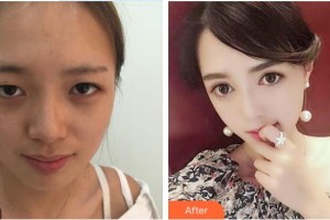 萍鄉(xiāng)麗芙整形美容醫(yī)院張志宏整形價(jià)格表附切開雙眼皮案例展示