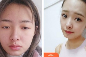 萍鄉(xiāng)麗芙整形美容醫(yī)院洪曼珊整形價(jià)格表附切開雙眼皮案例展示