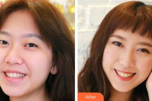 萍鄉(xiāng)星悅醫(yī)療美容診所胡喬整形價(jià)格表附切開雙眼皮案例展示