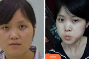 萍鄉(xiāng)優(yōu)美醫(yī)療美容門診部黎琳整形價(jià)格表附眼部綜合案例展示