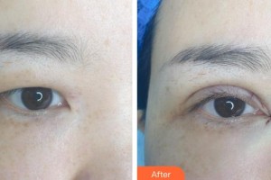 萍鄉(xiāng)優(yōu)美醫(yī)療美容門診部詹子慶整形價(jià)格表附眼部綜合案例展示