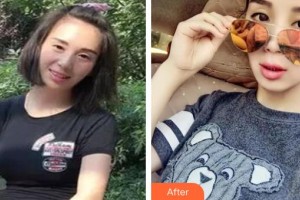 萍鄉(xiāng)薇尚醫(yī)療美容醫(yī)院夏清華整形價格表附激光美膚激光案例展示