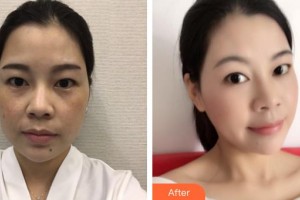 萍鄉(xiāng)薇尚醫(yī)療美容醫(yī)院李金文整形價格表附埋線提升案例展示