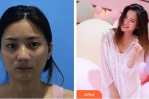 萍鄉(xiāng)薇尚醫(yī)療美容醫(yī)院賴啟煜整形價格表附埋線提升案例展示