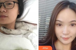 萍鄉(xiāng)恒生醫(yī)療美容診所鐘一鳴整形價格表附熱瑪吉案例展示