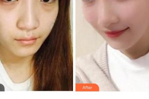 萍鄉(xiāng)百麗恒醫(yī)療美容診所廖云君整形價格表附埋線提升案例展示