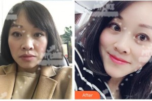 萍鄉(xiāng)星悅醫(yī)療美容診所陶軍整形價格表附埋線提升案例展示