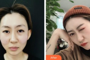 萍鄉(xiāng)星悅醫(yī)療美容診所嚴(yán)友才整形價格表附埋線提升案例展示