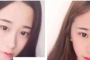 萍鄉(xiāng)愛爾眼科醫(yī)院李邦整形價格表附切開雙眼皮案例展示