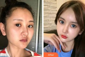 萍鄉(xiāng)愛爾眼科醫(yī)院劉松奇整形價(jià)格表附眼部綜合案例展示